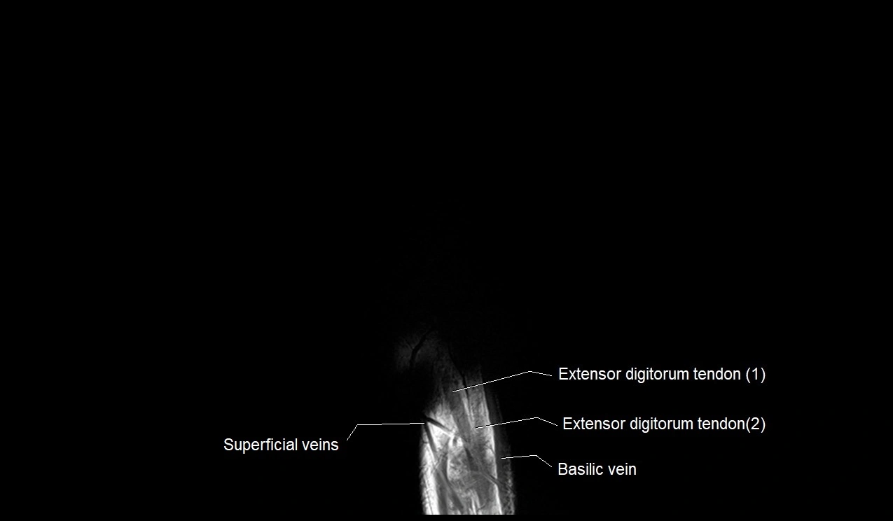 MRI 3T coronal hand cross sectional anatomy image 17.webp